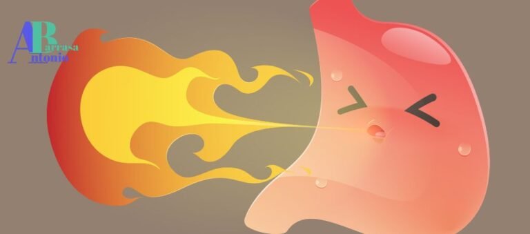 Enfermedad por reflujo gastroesofágico (ERGE)