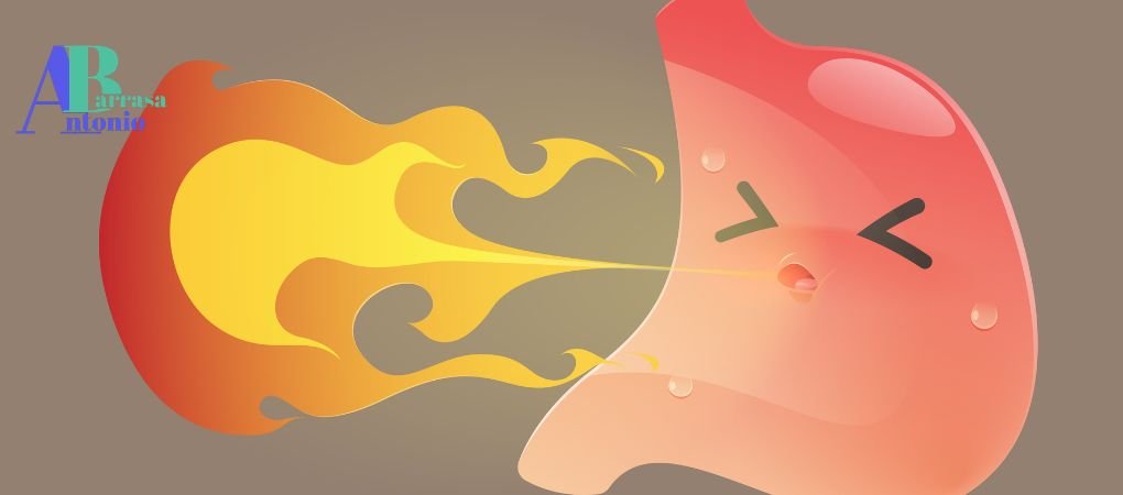 Enfermedad por reflujo gastroesofágico (ERGE)